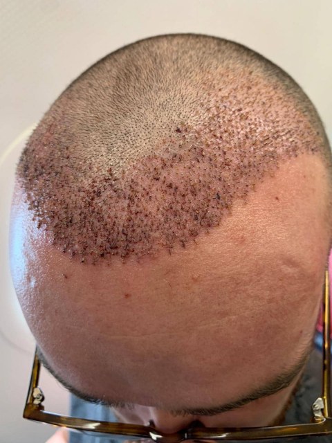 greffe.de_.cheveux.turquie14f23f10-7f6c-488e-bae5-e2ad16d3e055