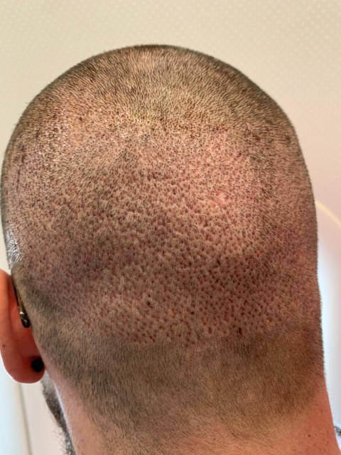 greffe.de_.cheveux.turquie2d5833b9-8e96-4fcf-91c6-f0c7393f8617