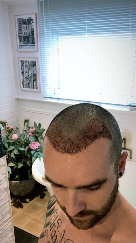 greffe.de_.cheveux.turquie2fea7bef-a3e2-4a11-a37e-cc29c816a911