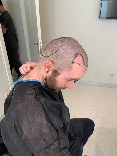 greffe.de_.cheveux.turquie4b0d99c1-651b-4576-bbef-8201e40fd449