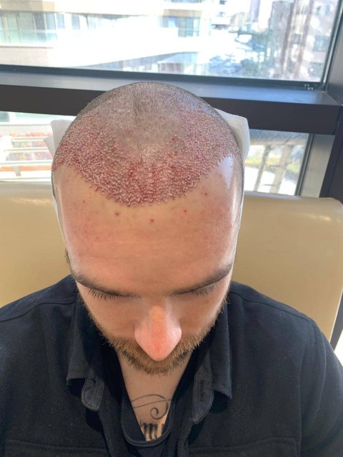 greffe.de_.cheveux.turquie5508d3c5-5cf2-4ab4-9af5-425f166ed03c