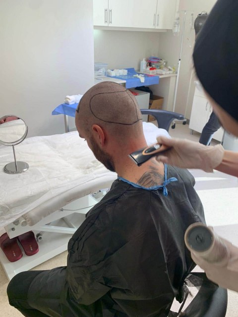 greffe.de_.cheveux.turquie6f33dcd6-1317-4a5b-b531-8dc53bc3294d