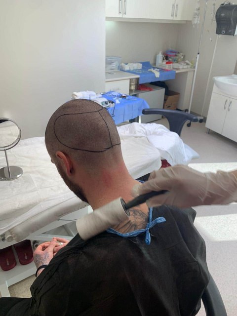 greffe.de_.cheveux.turquie9419227b-0316-472d-8730-05b137de6d3d