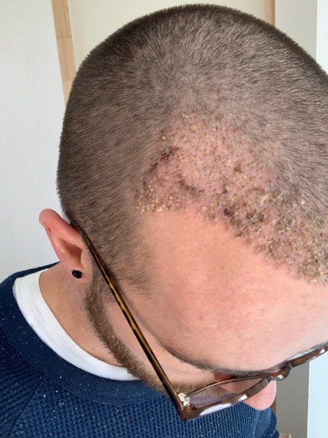 greffe.de_.cheveux.turquiea6e127b3-8478-4e93-bb26-26a3381c78df