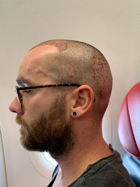 greffe.de_.cheveux.turquied6e937f6-3349-476d-9d99-6a8cb1d52afa