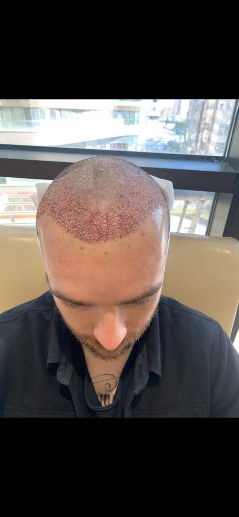 greffe.de_.cheveux.turquied7a42675-0560-4640-8480-35996042b53b