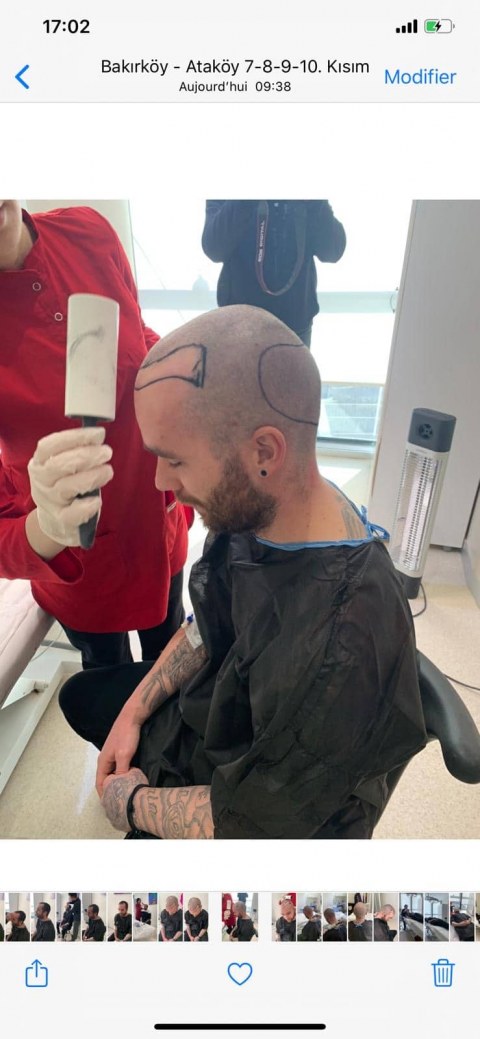 greffe.de_.cheveux.turquiee677787a-1c99-48c4-9f95-98ecb366678a